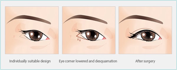lateral canthoplasty, double eyelid surgery, asian blepharoplasty, plastic surgery in korea
