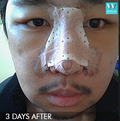 Men's plastic surgery - nose surgery, face contour story