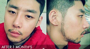 Men's plastic surgery - nose surgery, face contour story
